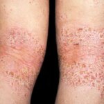 Is It Dry Skin or Atopic Dermatitis?