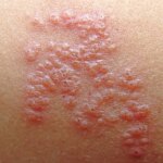 Pandemic and Costs Limited Use of Shingles Vaccine