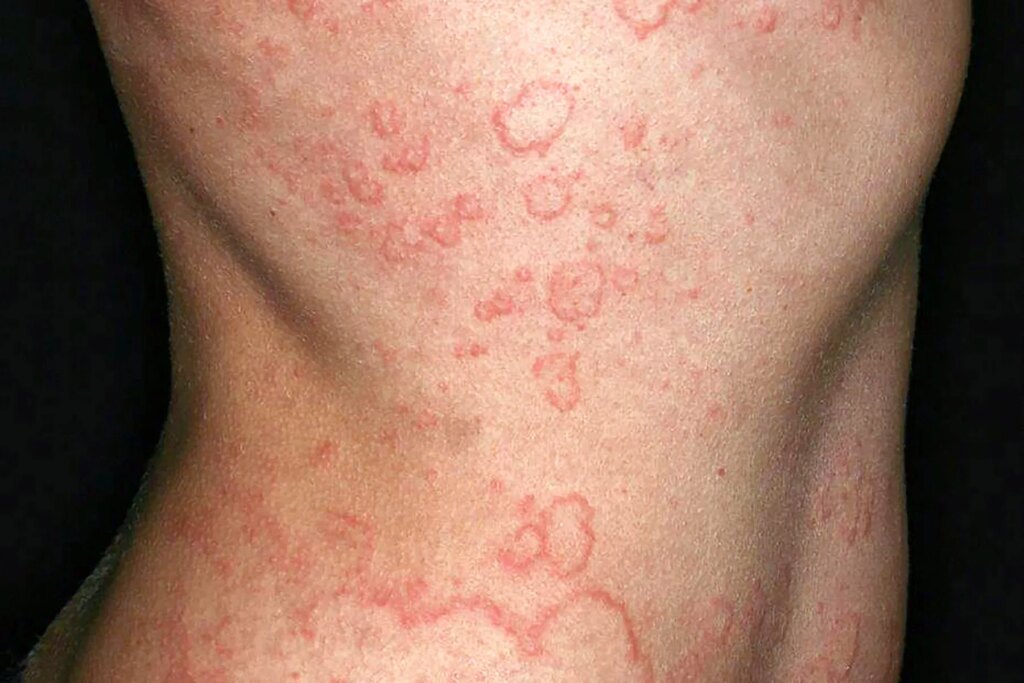 Chronic Spontaneous Urticaria: What to Know