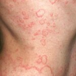 Chronic Spontaneous Urticaria: What to Know