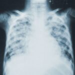 Community Acquired Pneumonia Often Inappropriately Diagnosed in Hospital Admissions