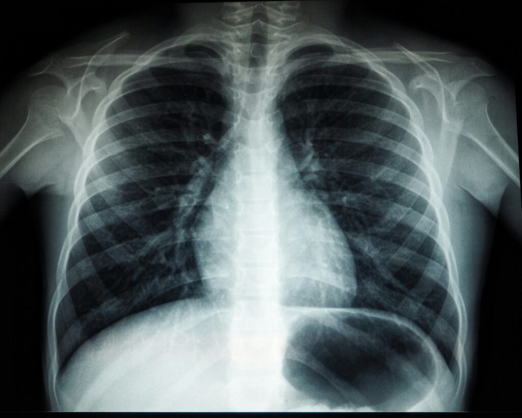 Despite a Negative Chest X-Ray, Majority of Patients Prescribed Antibiotics for Pneumonia