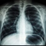 Despite a Negative Chest X-Ray, Majority of Patients Prescribed Antibiotics for Pneumonia